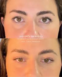 ✨ Paciente joven, cambio sutil, mirada renovada ✨, 💉 Antes vs. Después:  neuromoduladores en el tercio superior para una frente suave y natural, sin  perder tu expresión., 🌸 Menos líneas, más frescura… ...