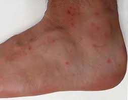 Dress to prevent chigger bites. File Chigger Bites Jpg Wikimedia Commons