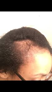 The huge bummer is that the same dose of finasteride was found to be ineffective for treating hair loss in women. I M Losing My Hair Will Propecia Regrow My Hair Quora