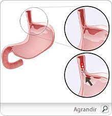 Le site est confus, les. Reflux Gastro Oesophagien Brulures D Estomac Symptomes