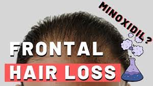 Sometimes the hair is lost from above the ears, or even from the back of the head. Frontal Hair Loss Does Minoxidil Work Youtube