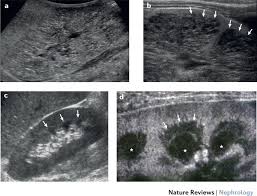 Hypertension is the leading cause of parenchymal renal disease, also known as chronic renal disease. Radiologic Imaging Of The Renal Parenchyma Structure And Function Nature Reviews Nephrology