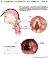 Image result for Reflux Laryngitis