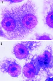 This paper aims to report a case of mesothelioma in a dog, obtained from the cytological analysis of pleural and abdominal fluid, which … Interleukin 6 Il 6 And Il 8 Are Induced In Human Oral Epithelial Cells In Response To Exposure To Periodontopathiceikenella Corrodens Infection And Immunity