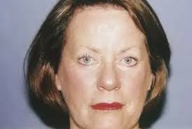 Eyelid Surgery Case 3