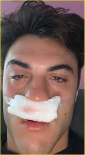 Dolan Twins Ethan & Grayson Undergo Sinus Surgery: Photo 1251921