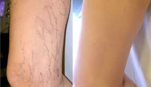 Pin On Veins