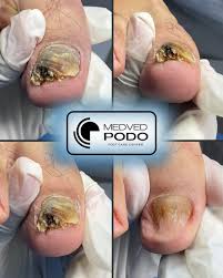 Image result for Onychotillomania feet