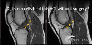 Huge Acl Surgery Cost Burden May Be Reduced By Injections Over Surgery Acl Surgery Surgery Meniscus Tear