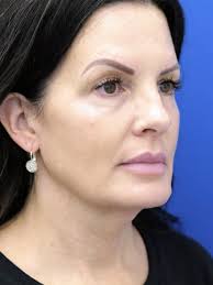 Cases in Facelift Deep Plane