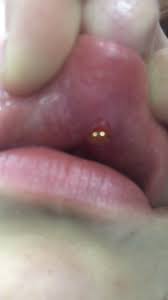 medusa piercing nach 7 monaten eiter