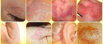 Check spelling or type a new query. Psoriasis Symptom Causes Types Treatment How To Relief