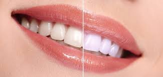 Teeth Whitening Westwood Cosmetic Dentist Lotus Family Dental