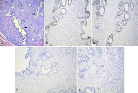 Borderline Phyllodes Tumor in a Child