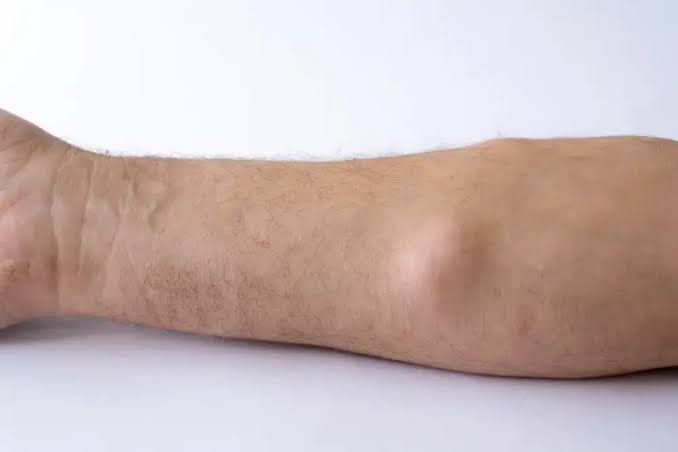 Lipoma Evaluation and Removal