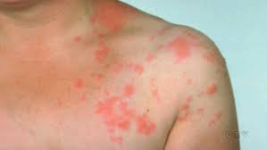 We did not find results for: Why Are More And More Canadian Adults Getting Shingles Ctv News