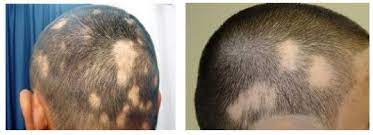 The number of aa cases included in the study and the inherent difficulty of conducting aa studies were cited by the researchers as study limitations. Hair Loss Strongly Associated With Poor Vitamin D Receptors Dec 2016 Vitamindwiki