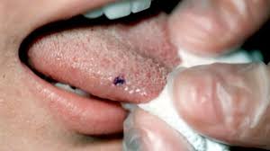Image result for black tongue symptoms