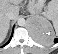Learn about symptoms, prognosis and treatment options now. Imaging Of Uncommon Retroperitoneal Masses Radiographics