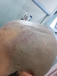 I have shaved my pubics for many years and had worked it out for myself. Didn T Shave My Head For 2 Weeks Now I Did And Can See Where It Itches Dandruff