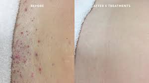 Be sure to shave 24 hours before your hair removal session. Ingrown Hair Bumps After Laser Hair Removal Kobo Guide