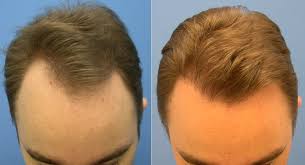 The skin is still extremely irritated from the hair transplant. Hair Loss Forum 3400 Grafts Dr Hasson 10 Months Hair Transplant Update