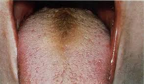 Image result for brown tongue symptoms