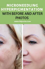 Microneedling Hyperpigmentation With Before And After Photos Microneedling Hyperpigmentation Derma Roller