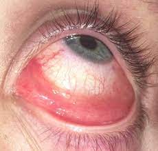 Auge Juckt Ist Rot Tut Weh Und Angeschwollen Bindehautentzundung Schwellung Rote Augen