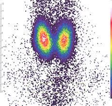 Diese reichern sich in einem speziellen organ oder. Nuramed Gemeinschaftspraxis Fur Radiologie Und Nuklearmedizin Schilddrusenszintigraphie