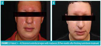 It caused a condition called morbihan disease, leaving my face permanently swollen, red and burning. Effective Treatment Of Morbihan S Disease With Long Term Isotretinoin A Report Of Three Cases Jcad The Journal Of Clinical And Aesthetic Dermatology