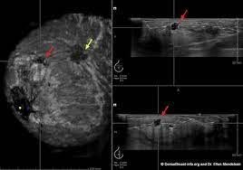Instead, breast skin can become thick, red, and look pitted. Breast Ultrasound Sonogram Densebreast Info Inc