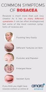 Do I Have Rosacea Rosacea Facts Advice Rosacea Sensitive Skin Treatment Rosacea Skin Care