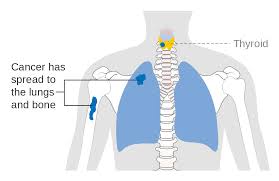 If you have a lump on it, chances are you found it yourself, though your doctor may have detected it it can show the size and location of thyroid cancer and whether it has spread to other parts of your. File Diagram Showing Stage M1 Thyroid Cancer Cruk 241 Svg Wikimedia Commons