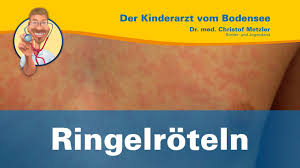Ringelröteln werden per tröpfcheninfektion übertragen und gelten generell als wenig ansteckend. Ringelroteln Alles Zur Krankheit Symptome Behandlung