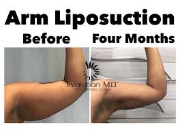 Burn Fat Arm Slimming Patch For Arms Slimmer For Women Detox Slim For  Weight Loss Patches Arms Slimming Fat Burner Patch | Lazada Ph