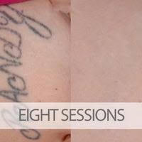 Yag from hoya conbio (perfect for. Eraditatt Tattoo Removal Palm Harbor Fl