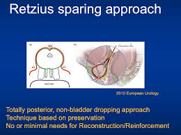 Image result for Radical Prostatectomy