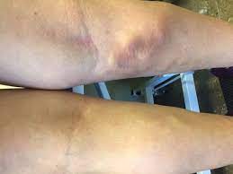 La trombosis venosa superficial puede causar molestias, pero no suelen causar la trombosis venosa superficial; Tromboflebitis O Trombosis Venosa Superficial Trombo Info