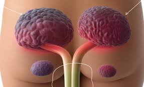 Image result for Hemorrhoid