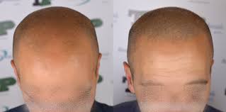 Cos'è la tricopigmentazione o micropigmentazione del cuoio capelluto. Tricopigmentazione Tatuaggio Semipermanente Per Capelli Beautyconsulting24