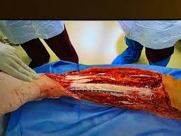 Nato Jacobs On Twitter Warning Graphic This Is What Alex Smith S Leg Looked Like A Week After His Injury And Eight Surgeries Project11