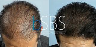 In oltre indicheremo i rimedi più efficaci per contrastare la caduta. Cura Alopecia Grosseto La Rigenerazione Follicolare Hairclinic