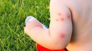 Gigitan serangga untuk melindungi sarang mereka. 5 Bahan Rumahan Dipercaya Sembuhkan Gigitan Nyamuk Pada Kulit Bayi Bisa Gunakan Madu Tribun Batam