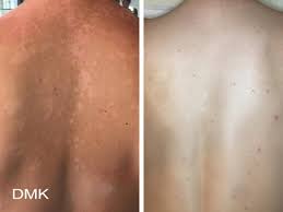 We are extremely impressed with this results driven professional paramedical treatment and home prescriptives. Dmk Body Enzyme Kay Co Cosmetic Rejuvenation