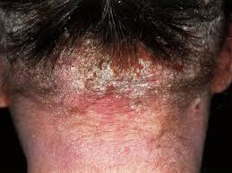 Image result for scabies norvegica