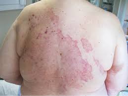 Ibc can best be described as. A Persistent Rash On The Back Chest And Abdomen Photo Quiz American Family Physician