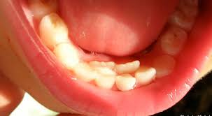 Xử lý tình huống răng vĩnh viễn mọc nhưng răng sữa chưa rụng.