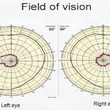 Perimetry Chart Field Of Vision Normal Vision Marked By
