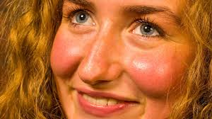Cheeks mengene kıskacı puff out the cheeks avurt şişirmek ne demek. Rosy Cheeks Rosacea Or Something Else Tips For Identification